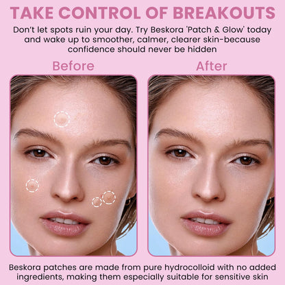 Patch & Glow Invisible Acne Patch